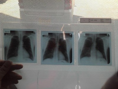 過去三年間の肺